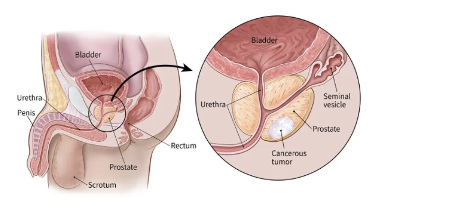 Prostate screening illustration